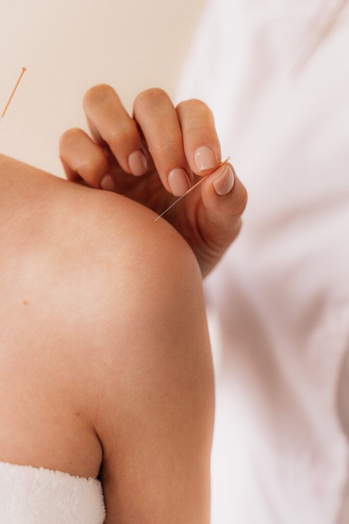 acupuncture to induce labor